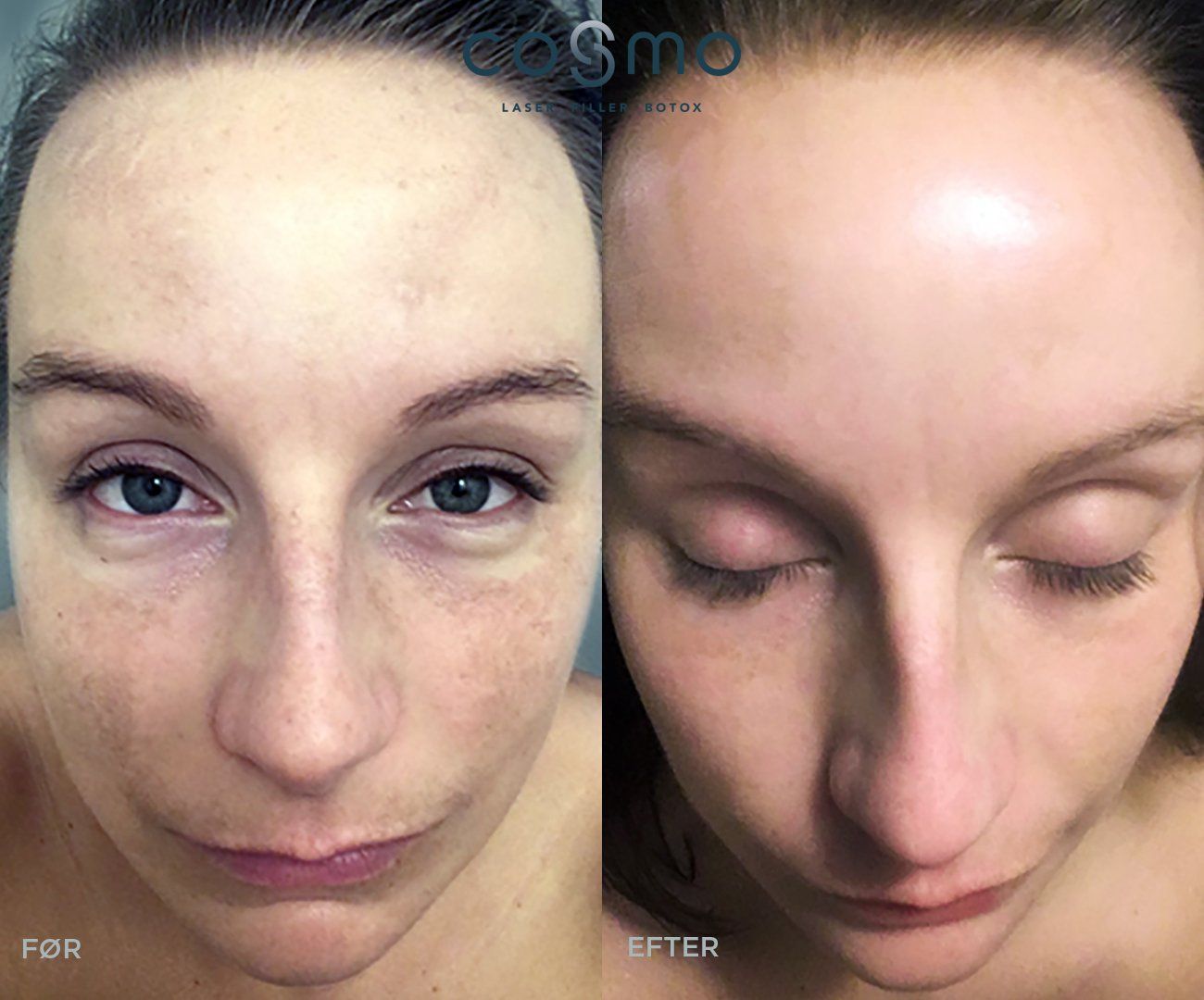 Før og efter pigmentbehandling af ansigt. Før og efter pigmentbehandling af ansigt.