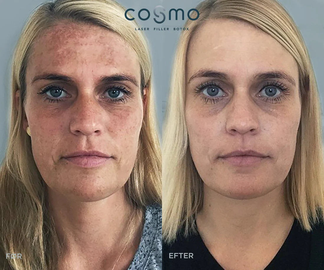 Før/efter laserbehandling af pigmentpletter i ansigtet. Resultater fra Cosmo Laser. Før/efter laserbehandling af pigmentpletter i ansigtet. Resultater fra Cosmo Laser.