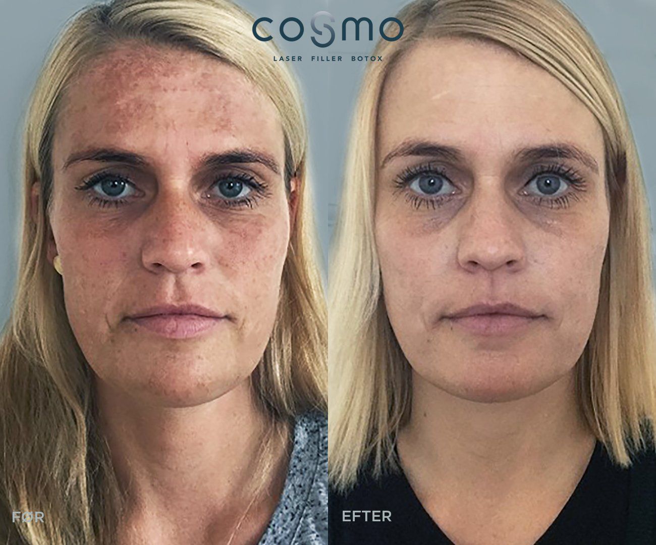 Før og efter pigmentbehandling hos Cosmo Laser. Før og efter pigmentbehandling hos Cosmo Laser.