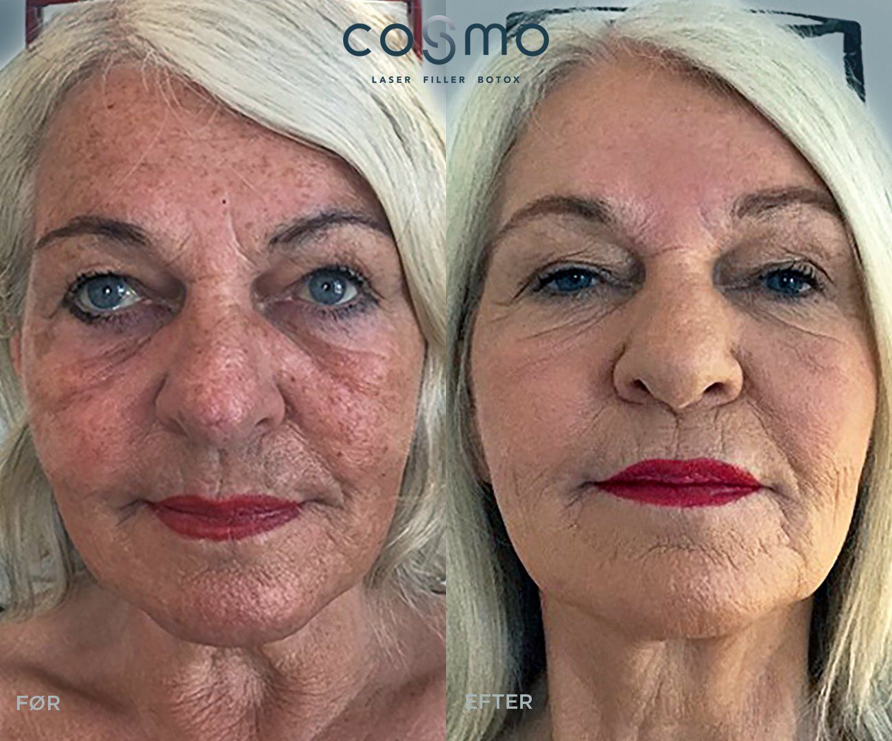 Før/efter laserbehandling af pigmentpletter hos Cosmo Laser. Synligt forbedret hudtone.