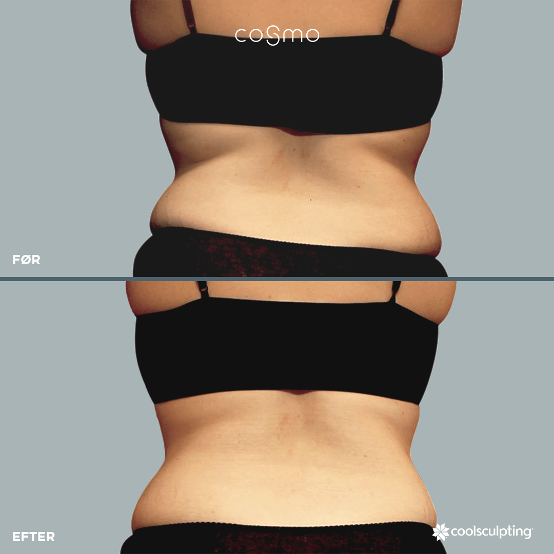 Før og efter fedtfrysning på ryg og håndtag.