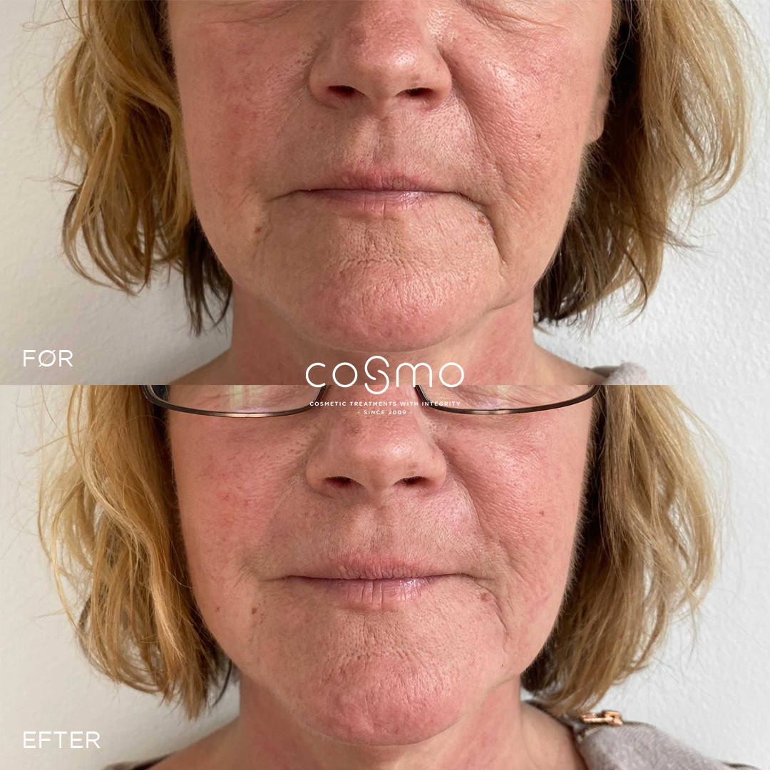 Før/efter: Botox og filler behandling af mundvige hos Cosmo Laser. Reducerer rynker effektivt. Før/efter: Botox og filler behandling af mundvige hos Cosmo Laser. Reducerer rynker effektivt.