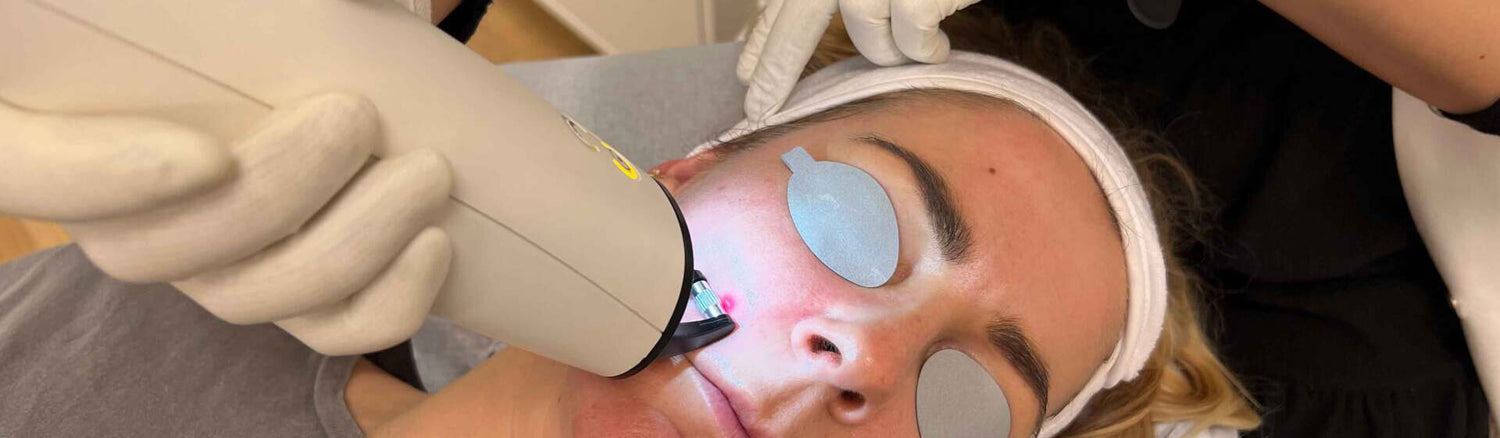Laserbehandling af ansigt hos Cosmo Laser. Patient med øjenbeskyttelse under behandling.