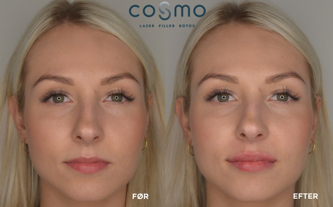 Natural lips by Cosmo - Cosmo Laser