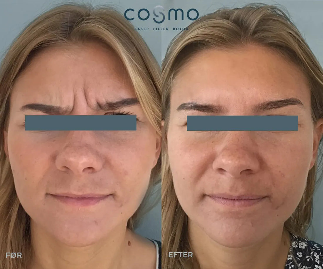 Fordomme om Botox - Cosmo Laser