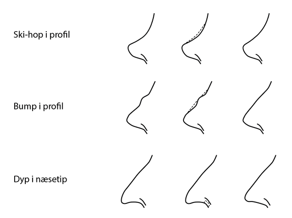 Guide: Hvilke områder kan behandles med filler? - Cosmo Laser