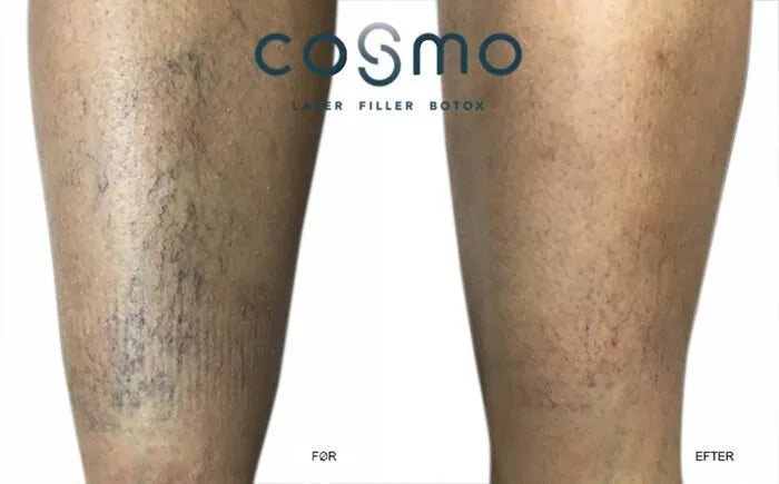 Sådan undgår du karsprængninger - Cosmo Laser