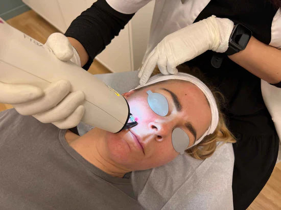 Behandling med Frax laser i Hørsholm