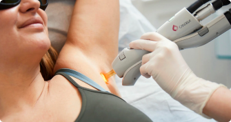 Derfor er april det perfekte tidspunkt at starte på permanent hårfjerning