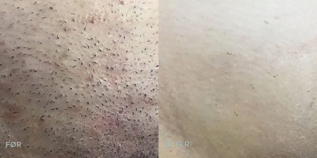 En hel sommer uden skraber. Ja tak! - Cosmo Laser