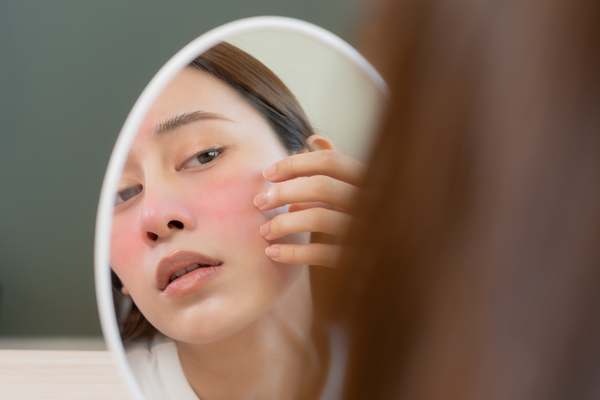 Hvad er Rosacea? - Lær mere om hudsygdommen