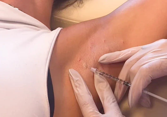 Hvor længe holder Botox mod sved?