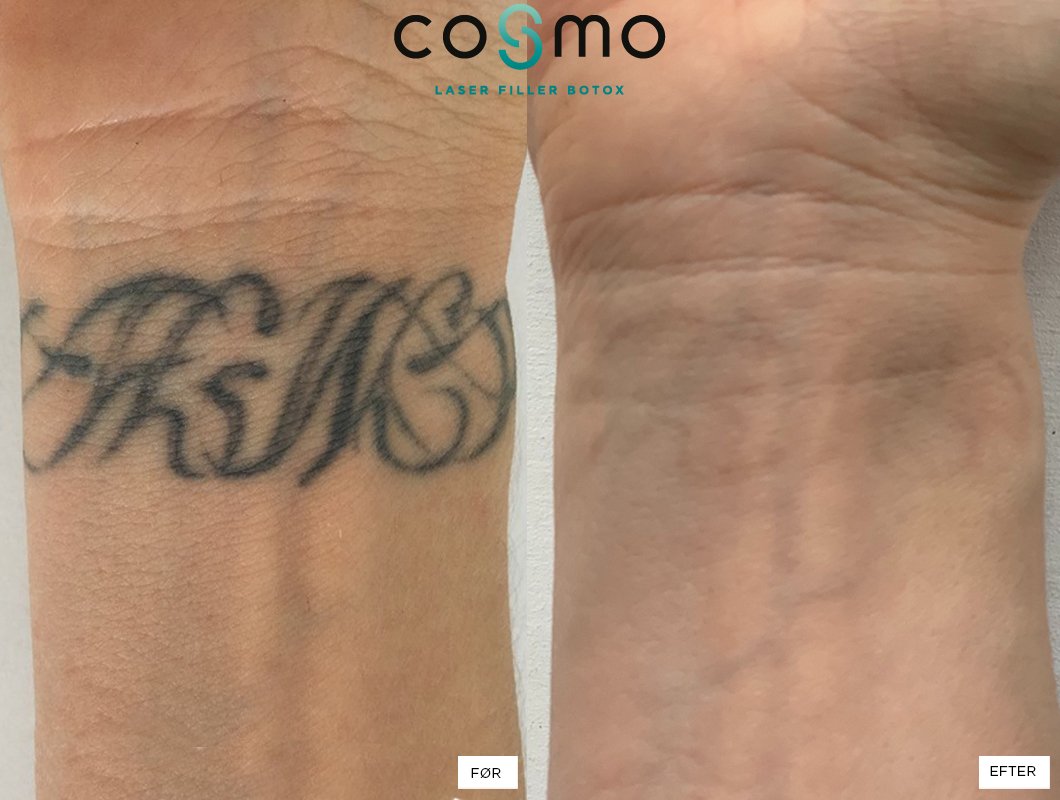 Skal du i mål med fjernelse af din tatovering? - Cosmo Laser