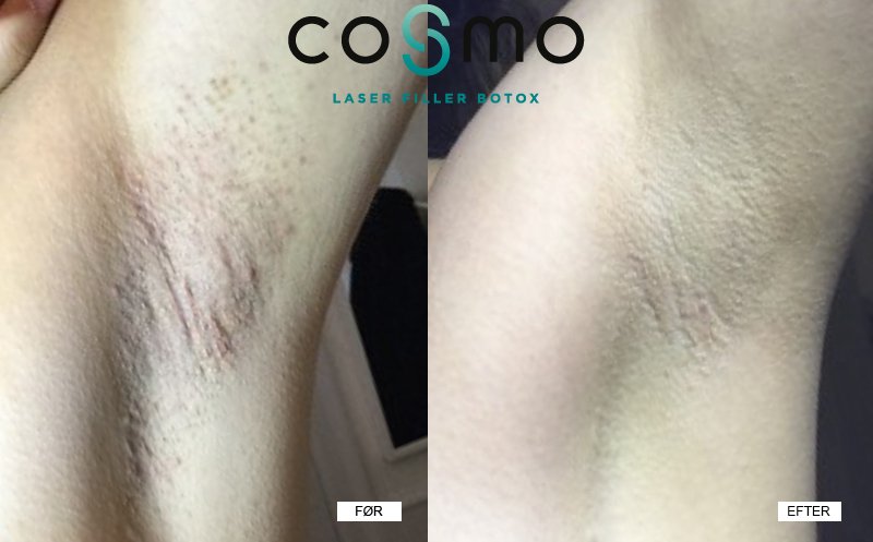 Tænk hvis du kunne slippe for indgroede hår - Cosmo Laser
