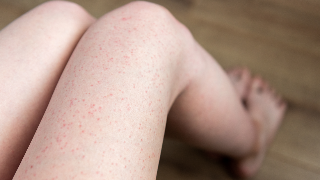 Træt af at kæmpe mod indgroede hår? Sådan virker laser på problemet