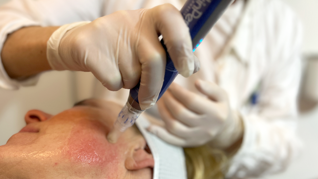 Microneedling