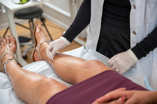 Kosmetisk laserbehandling på ben. Nøjagtig markering før behandling hos Cosmo Laser.