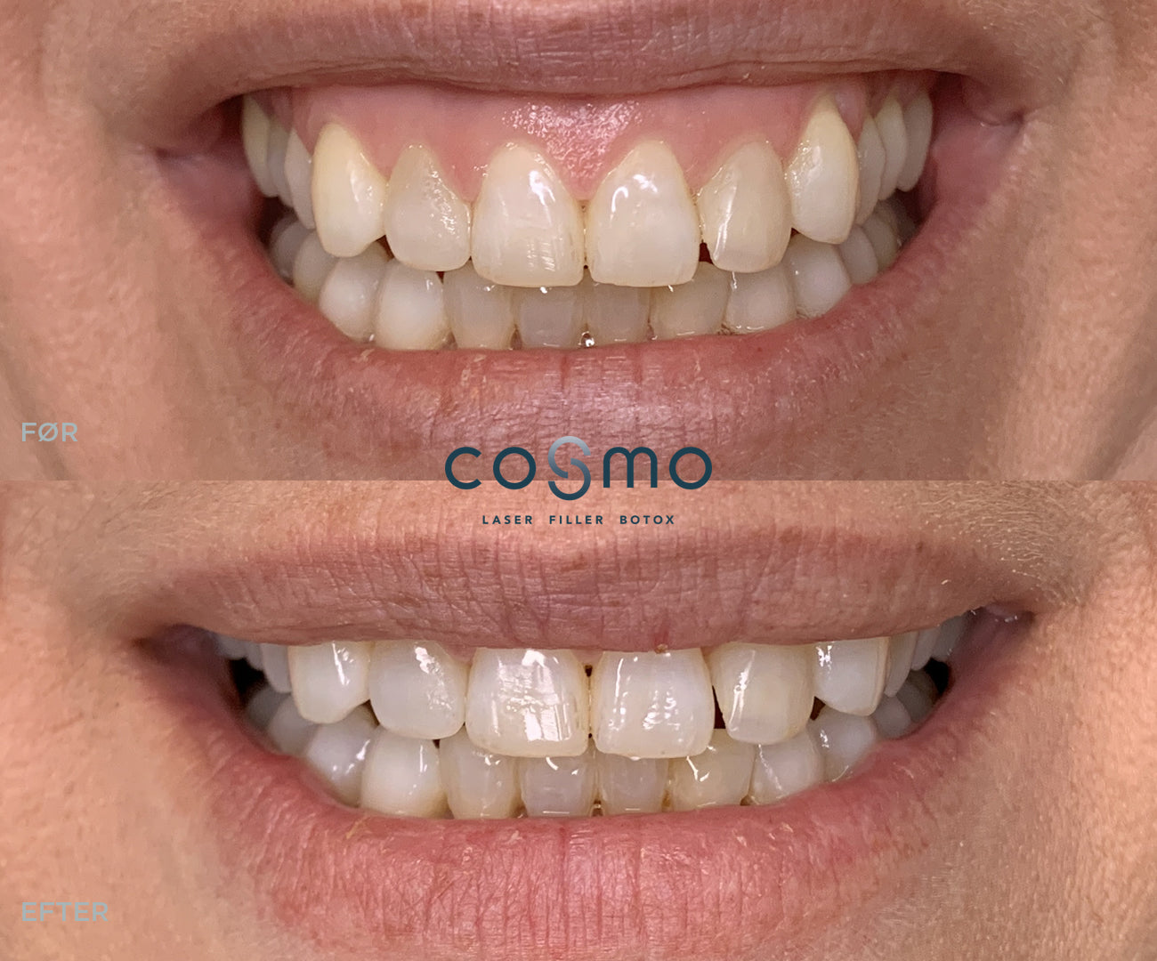 Før/efter billede: Botox behandling mod gummy smile hos Cosmo Laser. Flotte resultater!