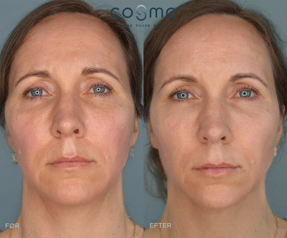 Før/efter Botox behandling hos Cosmo Laser. Synligt reducerer rynker og fine linjer for et forynget udseende.