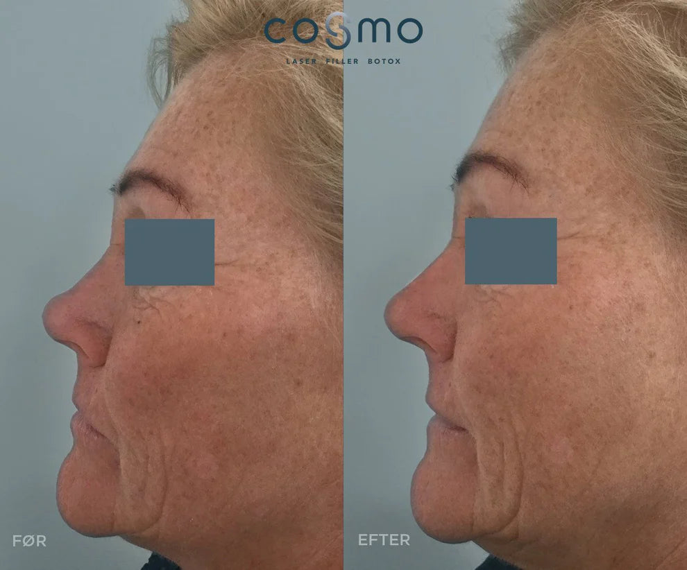Før/efter fillerbehandling af næseryg hos Cosmo Laser. Naturligt resultat med reduceret rynke.