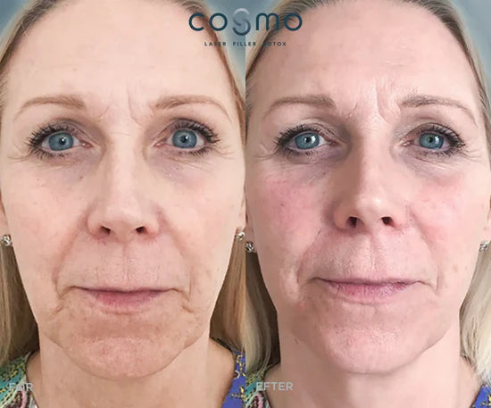 Før/efter billeder af naturlig filler-behandling hos Cosmo Laser. Resultater med fyldigere kinder og færre rynker.
