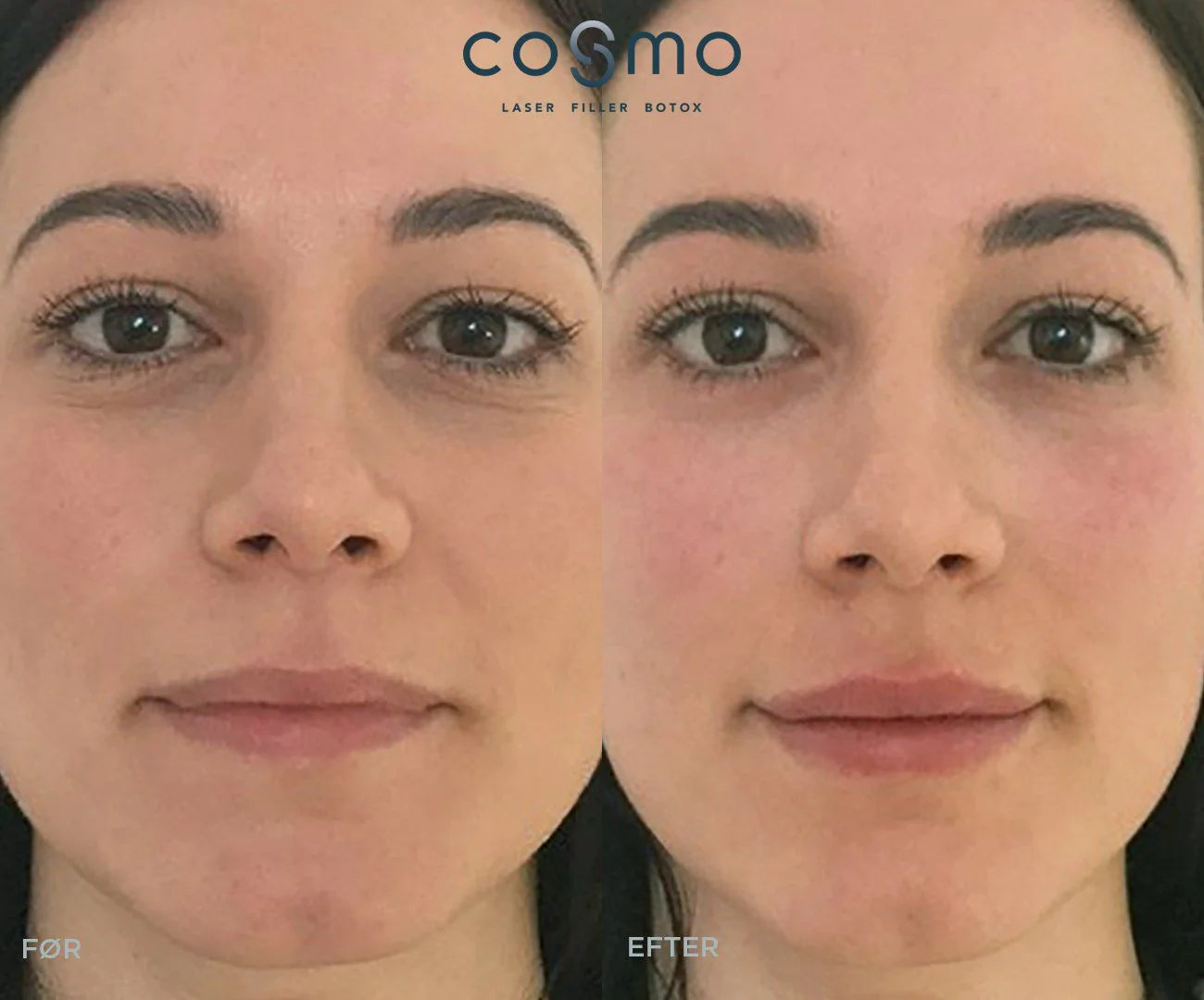 Før/efter billede af filler-behandling mod tåretrug hos Cosmo Laser.