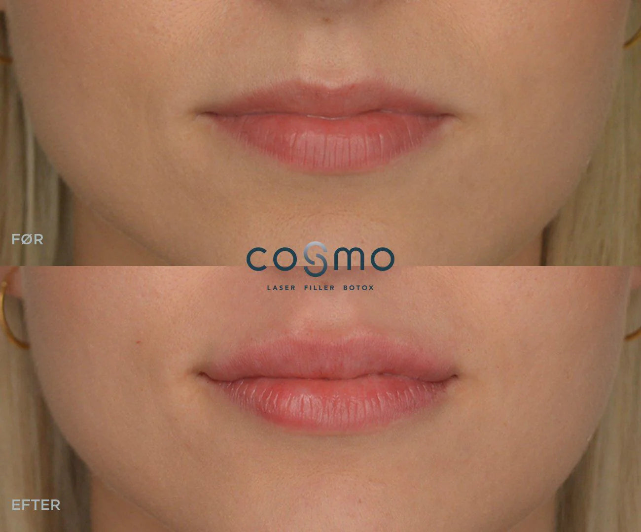 Før/efter billeder af læbeforstørrelse med filler hos Cosmo Laser. Naturligt og fyldigt resultat.