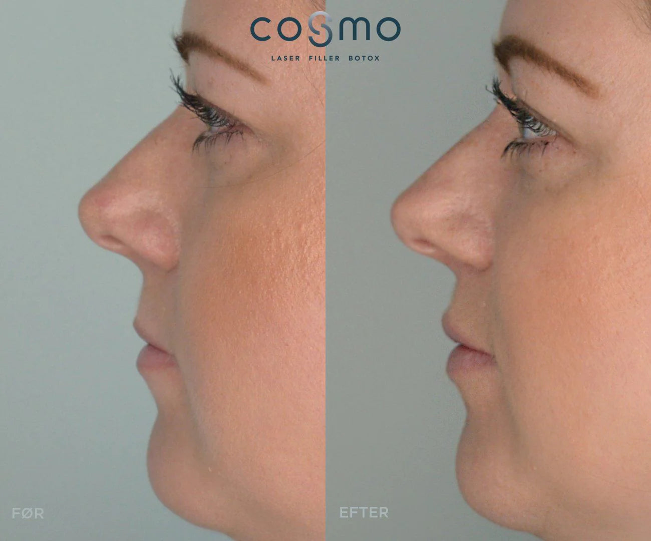 Før/efter: Læbeforstørrelse med filler hos Cosmo Laser. Naturligt resultat.