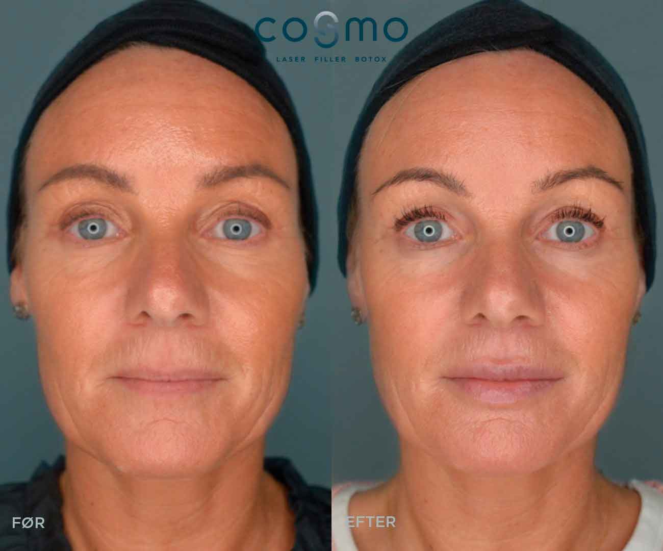 Før-og-efterbillede af fillerbehandling.