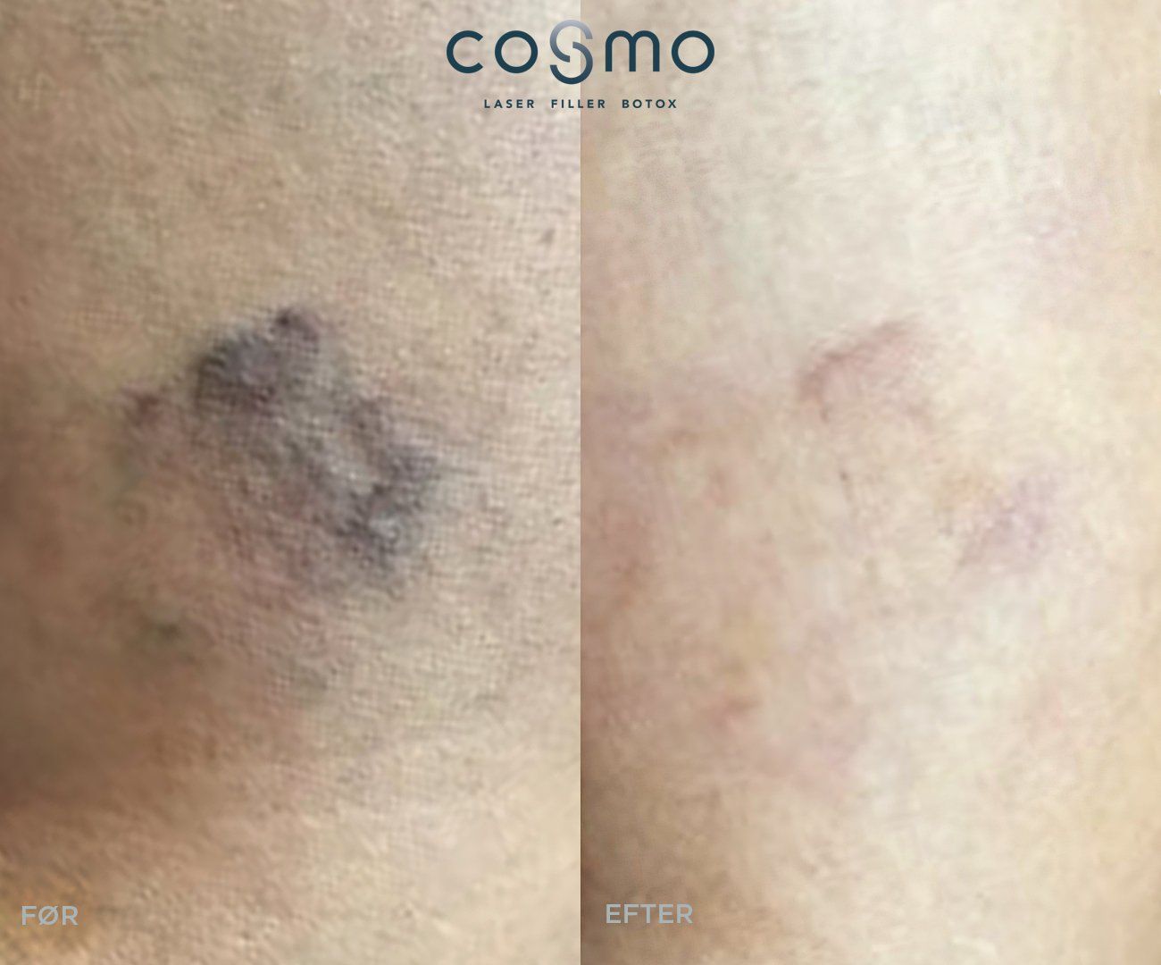 Før og efter karsprængningsbehandling.