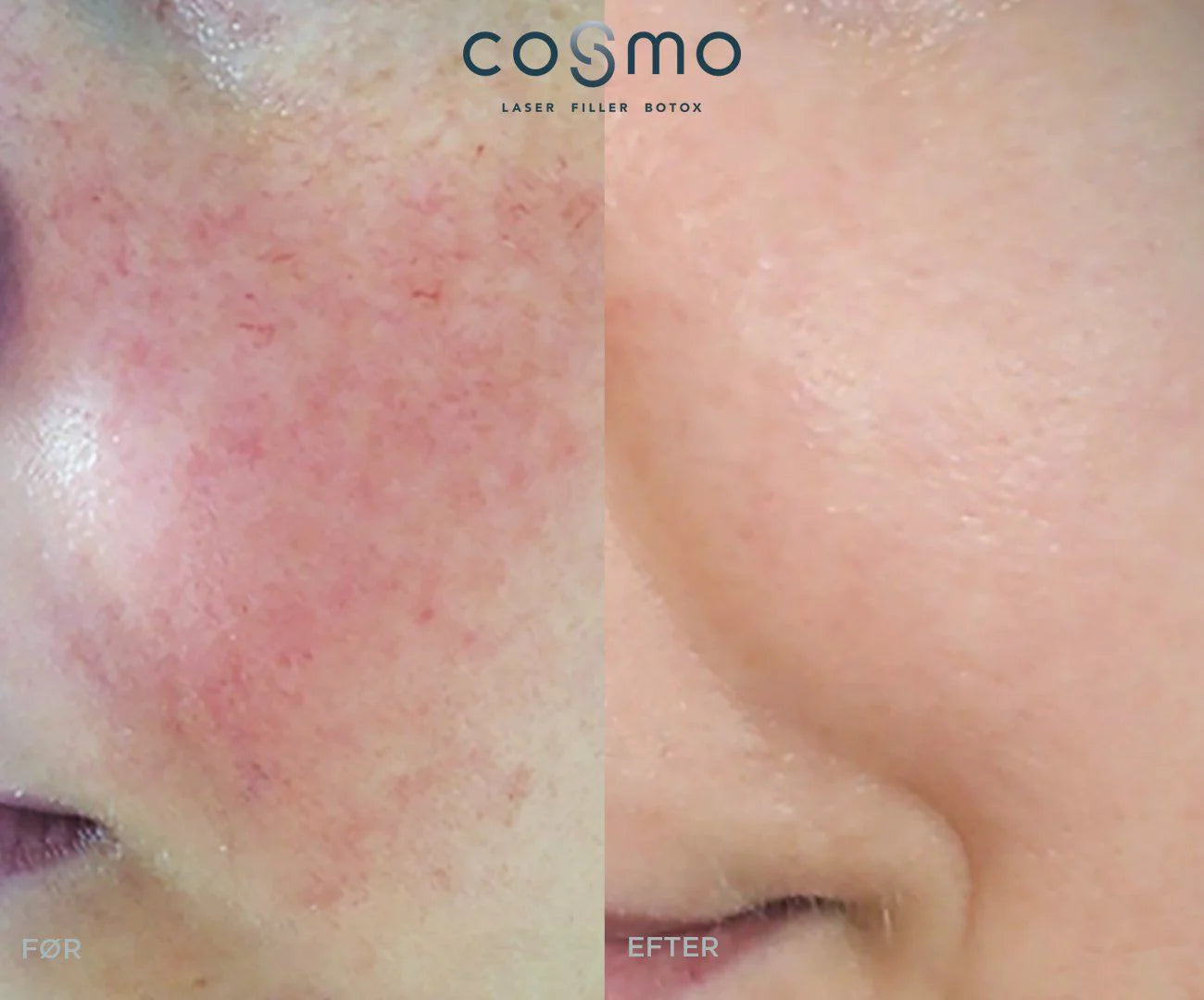 Før/efter karsprængninger i ansigtet. Effektiv behandling hos Cosmo Laser.