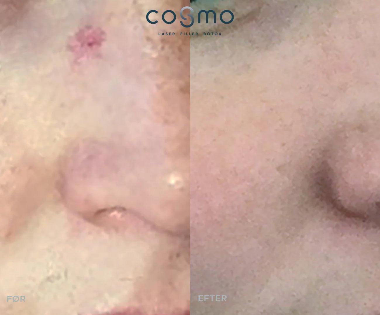 Før/efter-billede af karsprængninger behandlet hos Cosmo Laser. Effektiv behandling af kar i ansigtet.