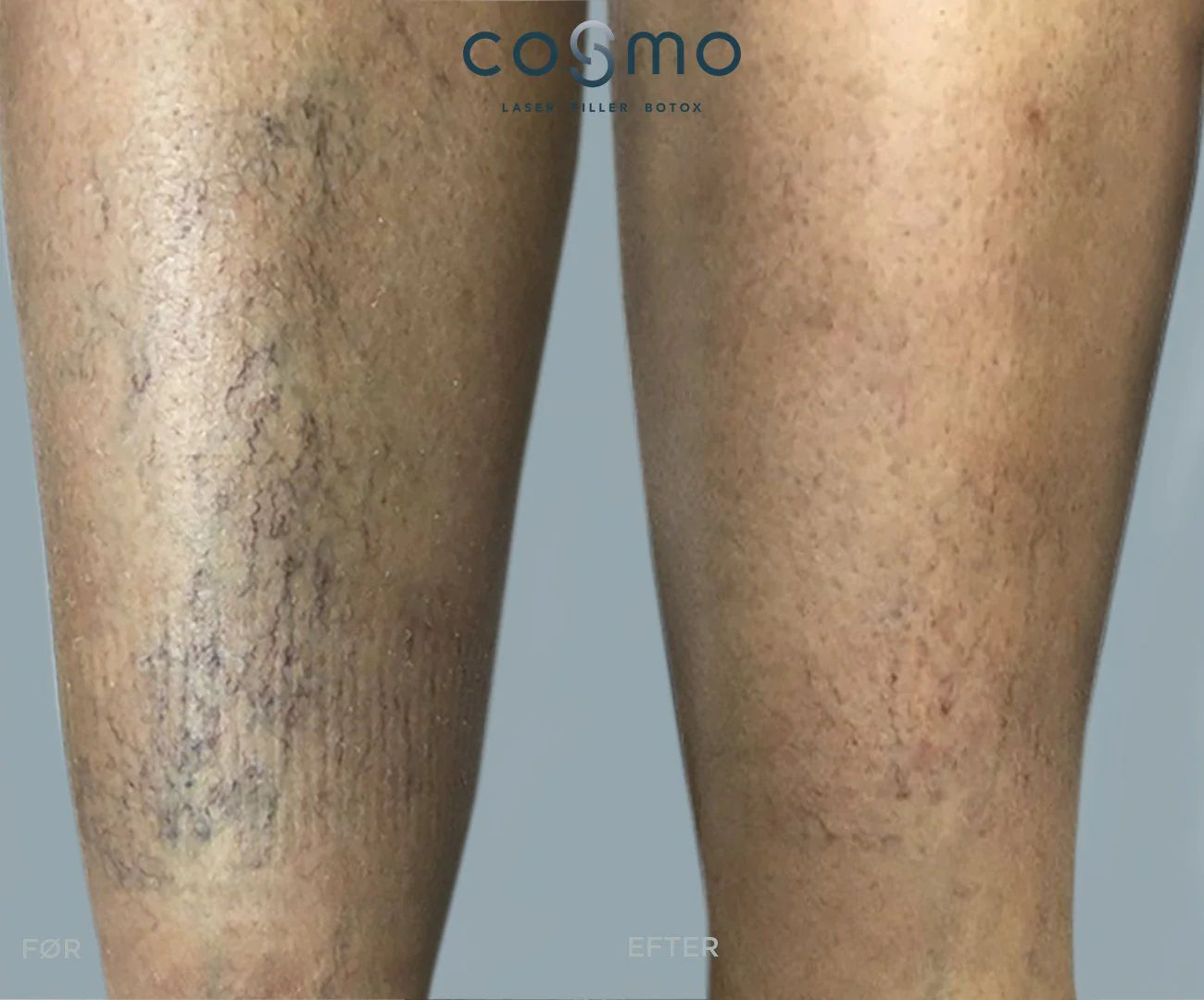 Før/efter-billede af karsprængninger på underben behandlet hos Cosmo Laser.