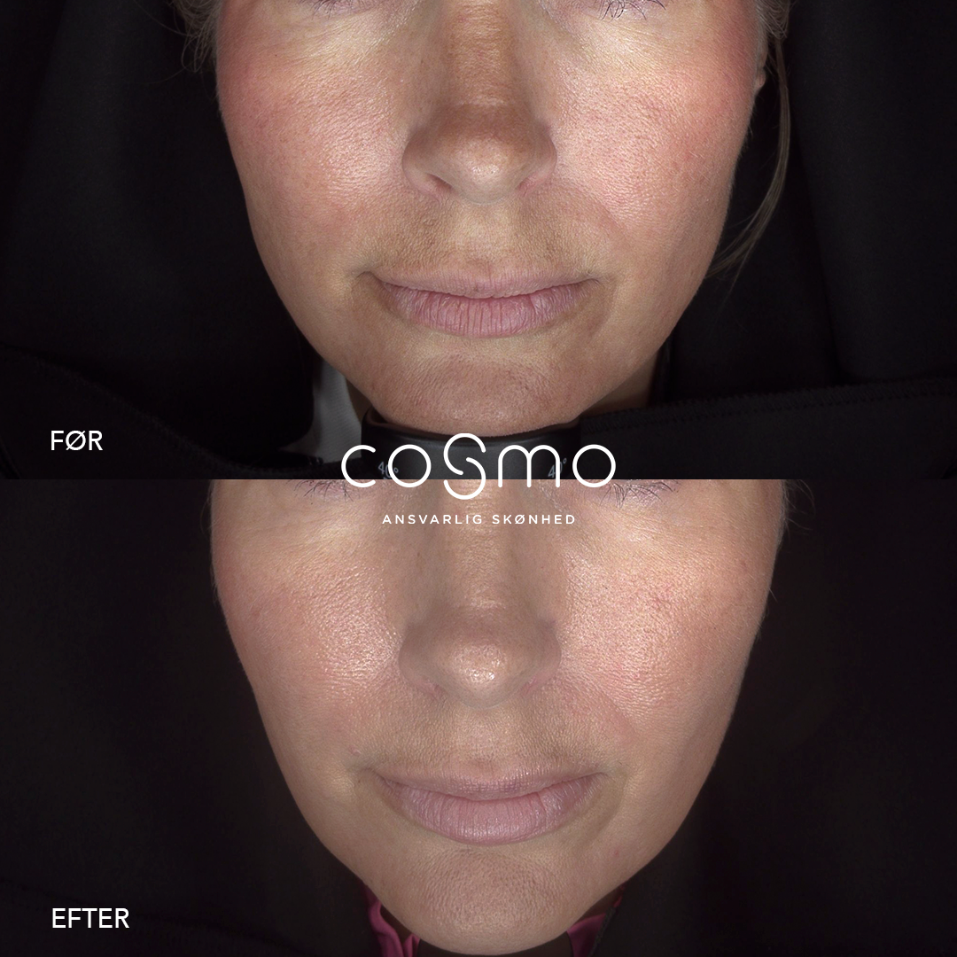 Før/efter laserbehandling hos Cosmo Laser. Forbedret hudtone og struktur.