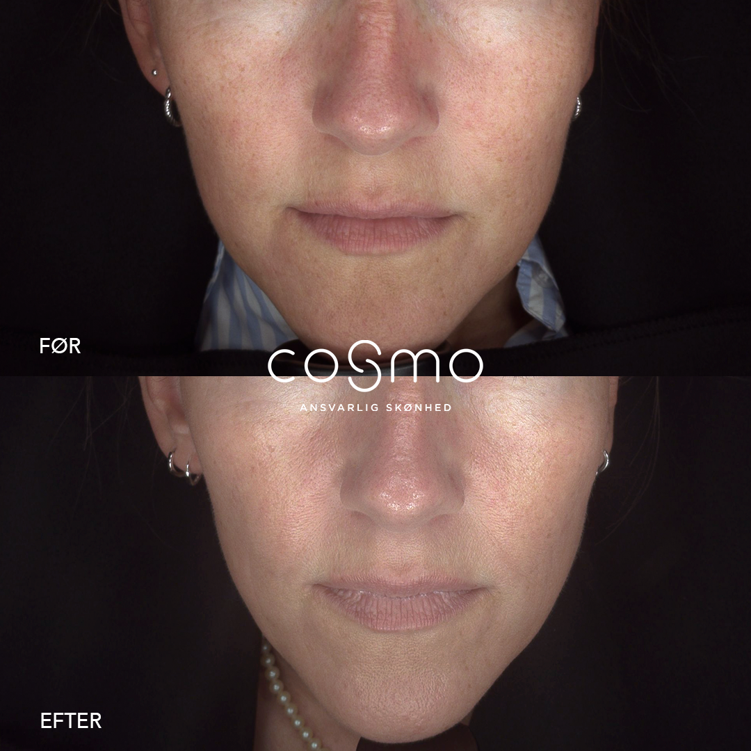 Før/efter laserbehandling hos Cosmo Laser. Synligt forbedret hudtone og reduceret rødme.