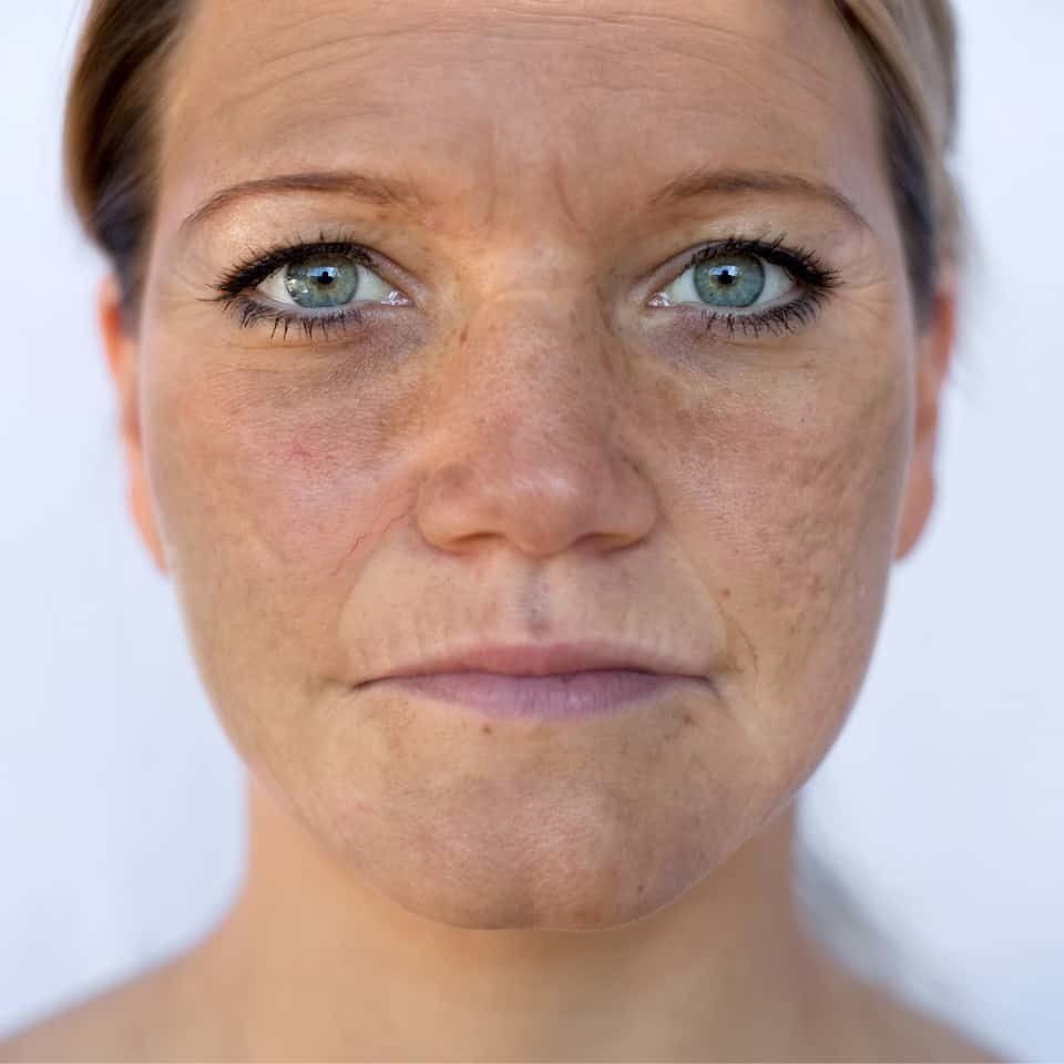 Ansigt med markerede områder, der hver peger på en behandling