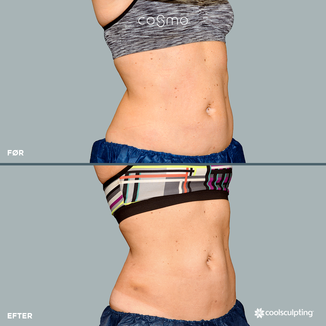 Fedtfrysning af maven - Før og efter billeder